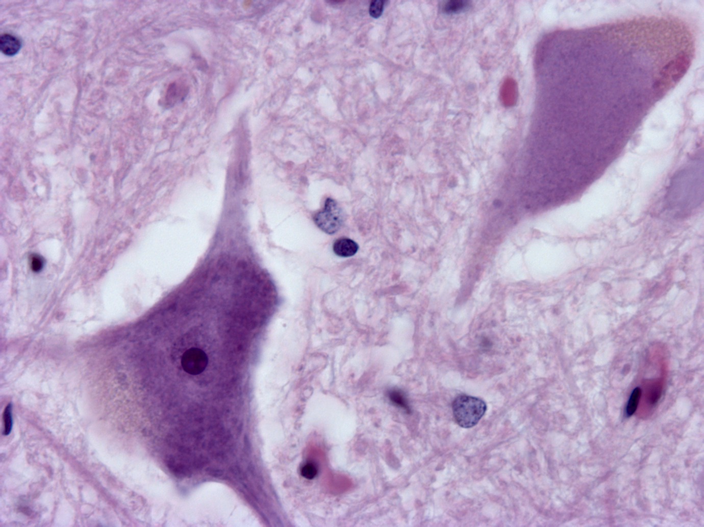 Página de Neuro-CEB sobre esclerosis lateral amiotrófica y recursos vinculados con investigación neuropatológica.
