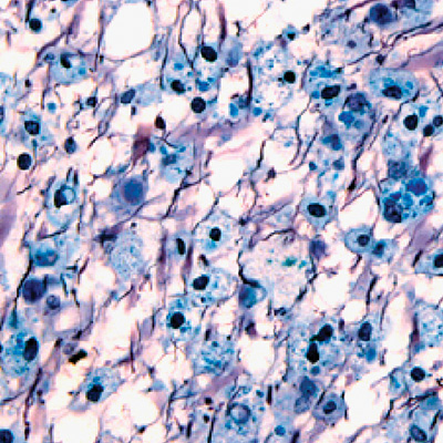 Macrophages contenant des débris de myéline (bleus) au sein d’une plaque (méthode argentique de Bodian associée à une coloration par le bleu de Luxol , X400)